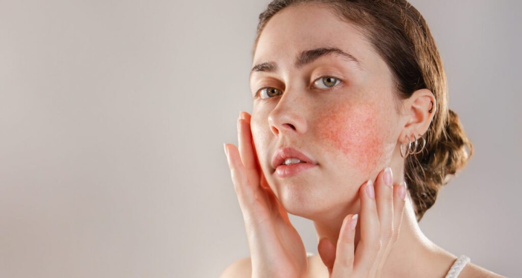 Rosacea kezelés