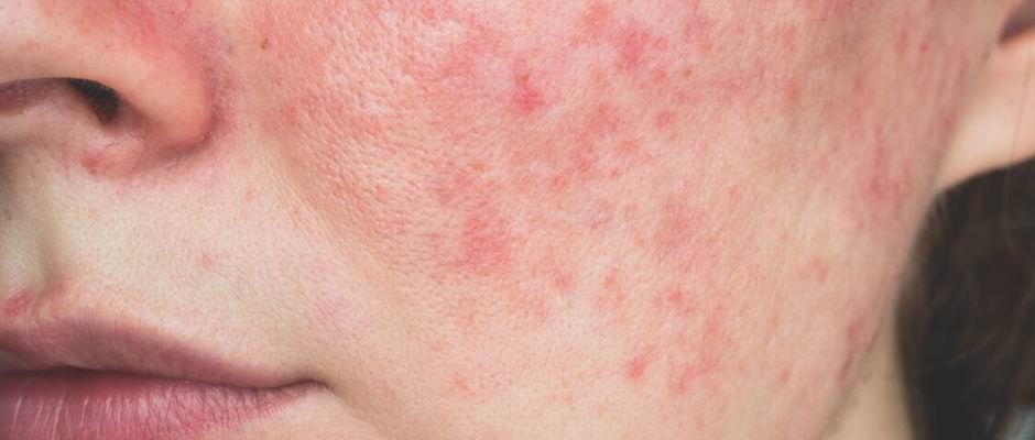 rosacea lézeres kezelés