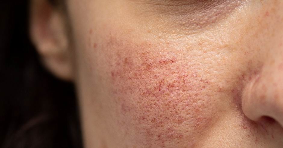 rosacea eltüntetése