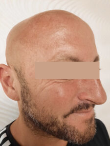 Botox kezelés után homlok, glabella, szarkalábak