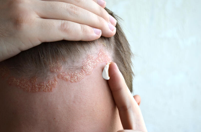 Seborrhea - Szeborreás bőr kezelése