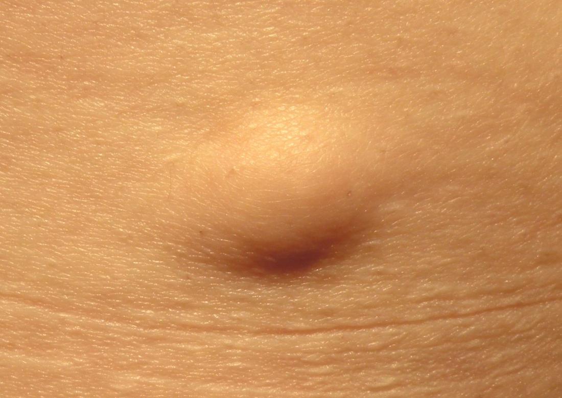 Lipoma kezelése